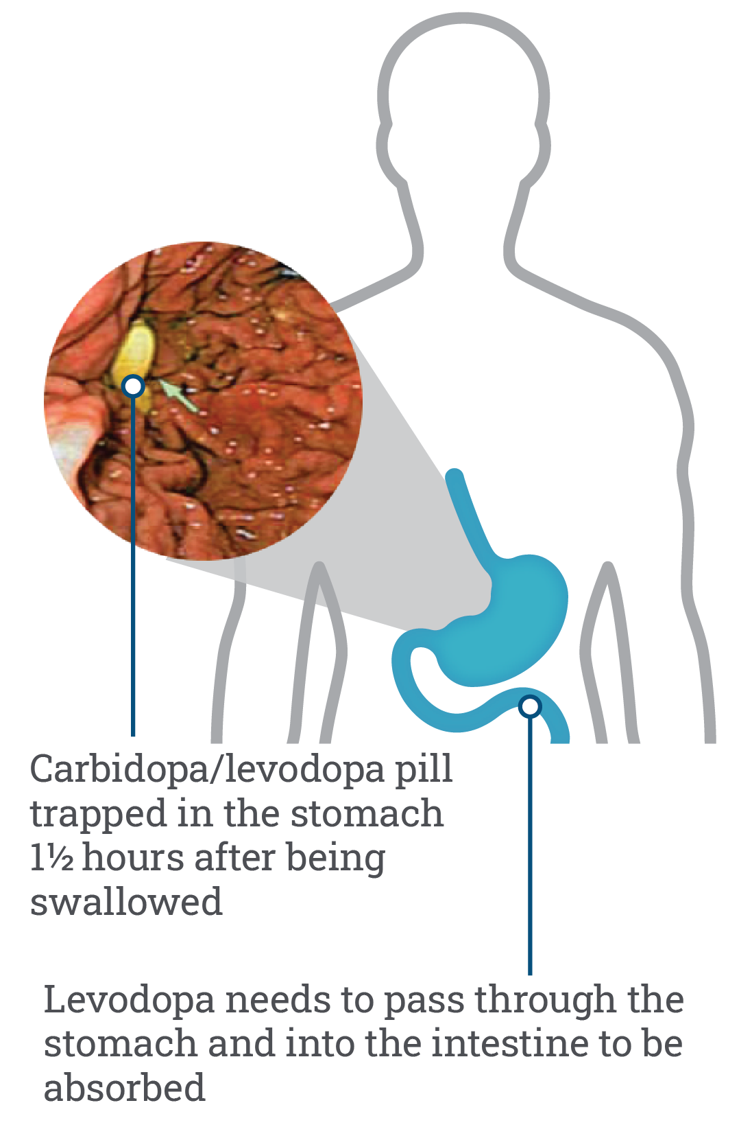 how-parkinson-s-disease-advances-duopa-carbidopa-levodopa